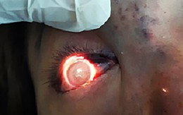 Nâng mũi làm đẹp, người phụ nữ ở Sài Gòn bị hỏng mắt trái