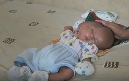 Bé trai Indonesia mắc dị tật hiếm gặp nhất: sinh ra với 2 khuôn mặt và 2 bộ não