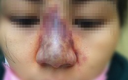 Làm đẹp bằng tiêm chất làm đầy (filler): Tai biến nguy hiểm, khó hồi phục