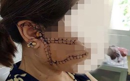 Lý do chưa khởi tố người chồng dùng dao rạch mặt, cắt gân chân "vợ hờ" ở Bắc Giang