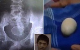 Hé lộ sự thật về cậu bé biết đẻ trứng tại Indonesia