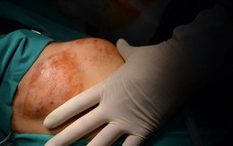 Tự chữa khối u ở ngực bằng thuốc nam, một phụ nữ nhận 'quả đắng'