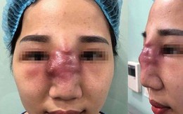 Nhiều vụ biến chứng sau tiêm filler làm đẹp: Đóa hoa đẹp bởi hương, không phải sắc