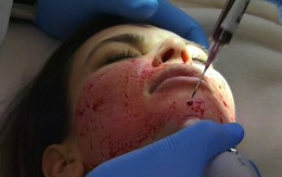 Làm đẹp bằng máu: Nên hay không nên?