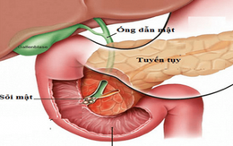 BS nói về bệnh viêm tuỵ khiến nam thanh niên tử vong: "Ít có bệnh nào chết nhanh như vậy!"