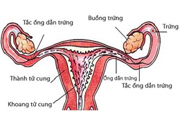 Nguyên nhân khiến tình trạng vô sinh ở VN tăng 20 lần, nhiều cặp dưới 30 tuổi đã vô sinh