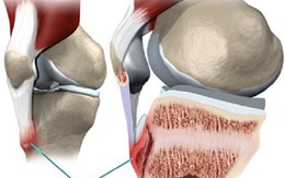 Người trẻ chớ chủ quan: BS khuyến cáo đây là loại ung thư thường gặp ở trẻ 9 – 19 tuổi