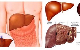 Khi nào người mắc bệnh gan không còn cơ hội cứu chữa?