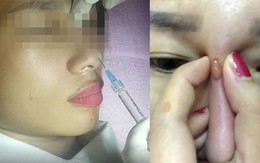 Mù mắt vì làm đẹp bằng filler nhưng nhiều người vẫn liều mạng