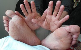 Đã có 6 trẻ tử vong do tay chân miệng: Dấu hiệu cảnh báo bạn phải đưa con đi cấp cứu ngay