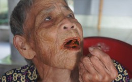 Cụ bà 98 tuổi mọc răng bất thường ở Hà Tĩnh