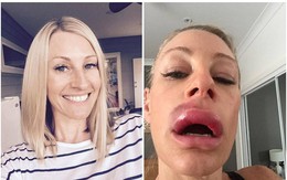 Kinh hoàng những ca tiêm filler làm đẹp