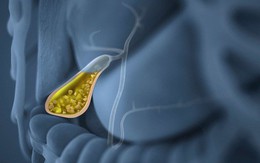 Một số loại thực phẩm có lợi và có hại cho sức khỏe túi mật bất kì ai cũng nên biết