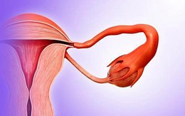 Đau bụng suốt 3 ngày sau, đến khi đi khám, bác sĩ phải tiến hành mổ thăm dò và phát hoảng khi nhìn vào bụng cô gái