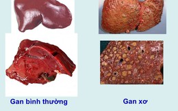 Khi cơ thể cùng lúc xuất hiện 4 dấu hiệu sau, có thể đã là xơ gan giai đoạn cuối