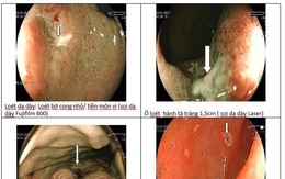 Loét dạ dày không điều trị có thể thành ung thư: Chuyên gia mách cách sống chung với bệnh