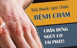 Bệnh chàm eczema: Dấu hiệu và cách chữa chặn đứng nguy cơ tái phát