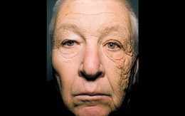 Nhìn những hình ảnh này mới thấy chính xác những thiệt hại của ánh nắng mặt trời gây ra cho làn da của bạn