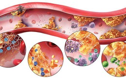Nhóm người dễ mắc mỡ máu cao: Cách nhận biết và phòng tránh hiệu quả, dấu hiệu "báo động"