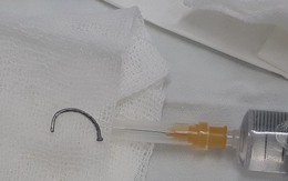 Bác sĩ rùng mình rút chiếc đinh uốn cong trong mắt bệnh nhân