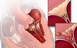 Bộ Y tế bác thông tin xuất hiện chủng virus "mới, lạ" gây viêm cơ tim