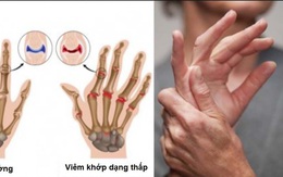 11 lý do khiến bệnh viêm khớp dạng thấp "tấn công" nhiều người: Nên điều chỉnh lại ngay