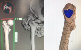 Lần đầu tiên ở VN: Cắt khối u xương to như cây súp lơ, ghép xương đùi nhân tạo cho bệnh nhân