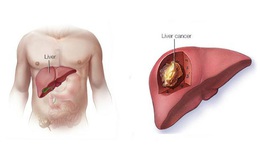 Dưỡng gan đúng hay sai đều bắt đầu từ việc ăn uống, đây là 4 việc bác sĩ rất tán thành