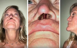 Xót xa người phụ nữ 11 năm sống với một lỗ mũi