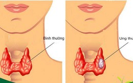 Nuốt nước bọt mà có dấu hiệu này, có khả năng bị ung thư tuyến giáp