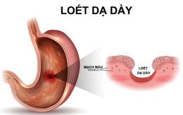 4 thói quen ăn uống rất có hại cho hệ tiêu hóa: Nếu ăn trong lâu dài thì dạ dày sẽ hỏng