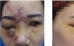 Cô gái 27 tuổi mù một bên mắt sau khi nâng mũi