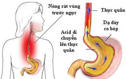 Trào ngược thực quản có thể biến chứng thành ung thư: GS tiêu hoá mách cách "sống chung"