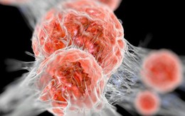 PCT Hội Ung thư chỉ cách phát hiện 3 loại ung thư hay mắc nhất trước khi có dấu hiệu bệnh