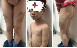 Bác sỹ Bệnh viện Việt Đức và vợ kế bị tố bạo hành con trai bầm tím khắp người