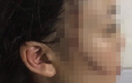 Cô gái 18 tuổi bị nhóm bạn xông vào phòng trọ rạch mặt, khâu 60 mũi ở Bắc Ninh