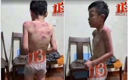 Thanh Hóa: Công an xác minh thông tin bé trai bị cha dượng bạo hành dã man