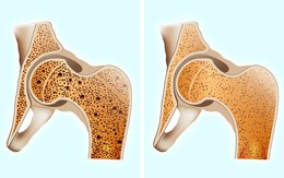 Xương khớp là nền móng trụ cột của cơ thể: Nên ăn 6 thực phẩm giúp xương chắc bền