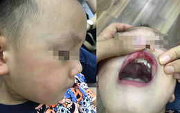 Cô giáo ở Hà Nội tát bé hơn 2 tuổi sấp mặt, tụ máu môi đang bị hoảng loạn và có suy nghĩ quẩn