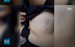 SBS công khai hình ảnh thương tích của cô dâu Việt sau khi bị chồng người Hàn bạo hành, một lần nữa khiến dân mạng căm phẫn
