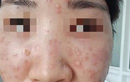 Ham làm đẹp, người phụ nữ hoảng hốt mặt nổi toàn mụn... lạ