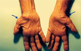 Dấu hiệu đau nhói, tê đầu ngón tay cảnh báo những vấn đề sức khỏe cực nghiêm trọng