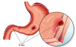 BS cảnh báo: Người trẻ mắc bệnh dạ dày ngày càng nhiều là do đã "cố ý" làm sai 2 điều