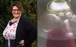 Đang mang thai tháng thứ 9, người phụ nữ đột ngột ngất xỉu trước khi phát hiện điều kỳ lạ trong buồng trứng khiến cô mãn kinh ở tuổi 23