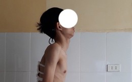 Hà Nội: Thanh niên bị gù nặng được phẫu thuật thẳng lưng trở lại