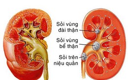 Bác sĩ thận - tiết niệu mách bạn cách đẩy lùi bệnh sỏi thận, không cần phẫu thuật