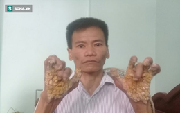 Người cây ở Ninh Bình: Số phận cay đắng vì mắc căn bệnh ngoài da khủng kiếp nhất thế giới
