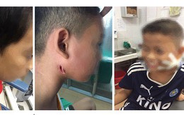 3 trẻ nhỏ xứ Nghệ bị "vi khuẩn ăn thịt người" tấn công tuyến nước bọt mang tai