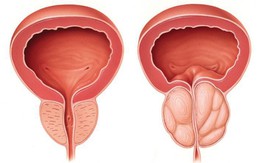 Nam giới xuất hiện 4 dấu hiệu này, có thể là tuyến tiền liệt đang "kêu cứu"