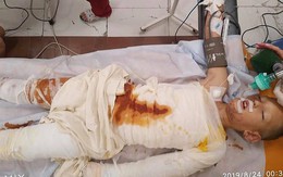 Đang chơi ở sân chung cư, cậu bé 8 tuổi bất ngờ bị một đám trẻ tưới xăng lên người và thiêu sống